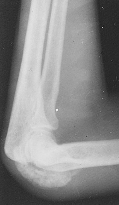 Fig. 31.3, Tumoral calcinosis in right elbow region of an 18-year-old man. Radiograph shows calcified mass in elbow region.