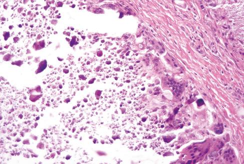 Fig. 31.5, Tumoral calcinosis with characteristic mixture of calcified material, histiocytes, and multinucleated giant cells.