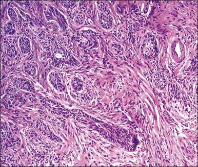 Figure 13.1, Adenoid basal carcinoma (epithelioma) composed of round, oval, or slightly distorted nests.