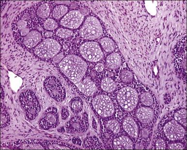 Figure 13.4, Adenoid cystic carcinoma.