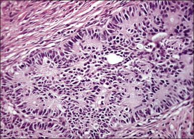 Figure 13.5, Typical (classic) carcinoid tumor.