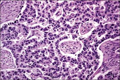 Figure 13.6, Atypical carcinoid tumor with trabecular pattern.