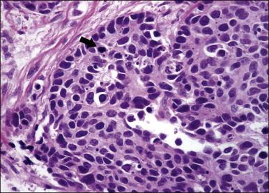 Figure 13.7, Atypical carcinoid tumor with mitotic figure (arrow).