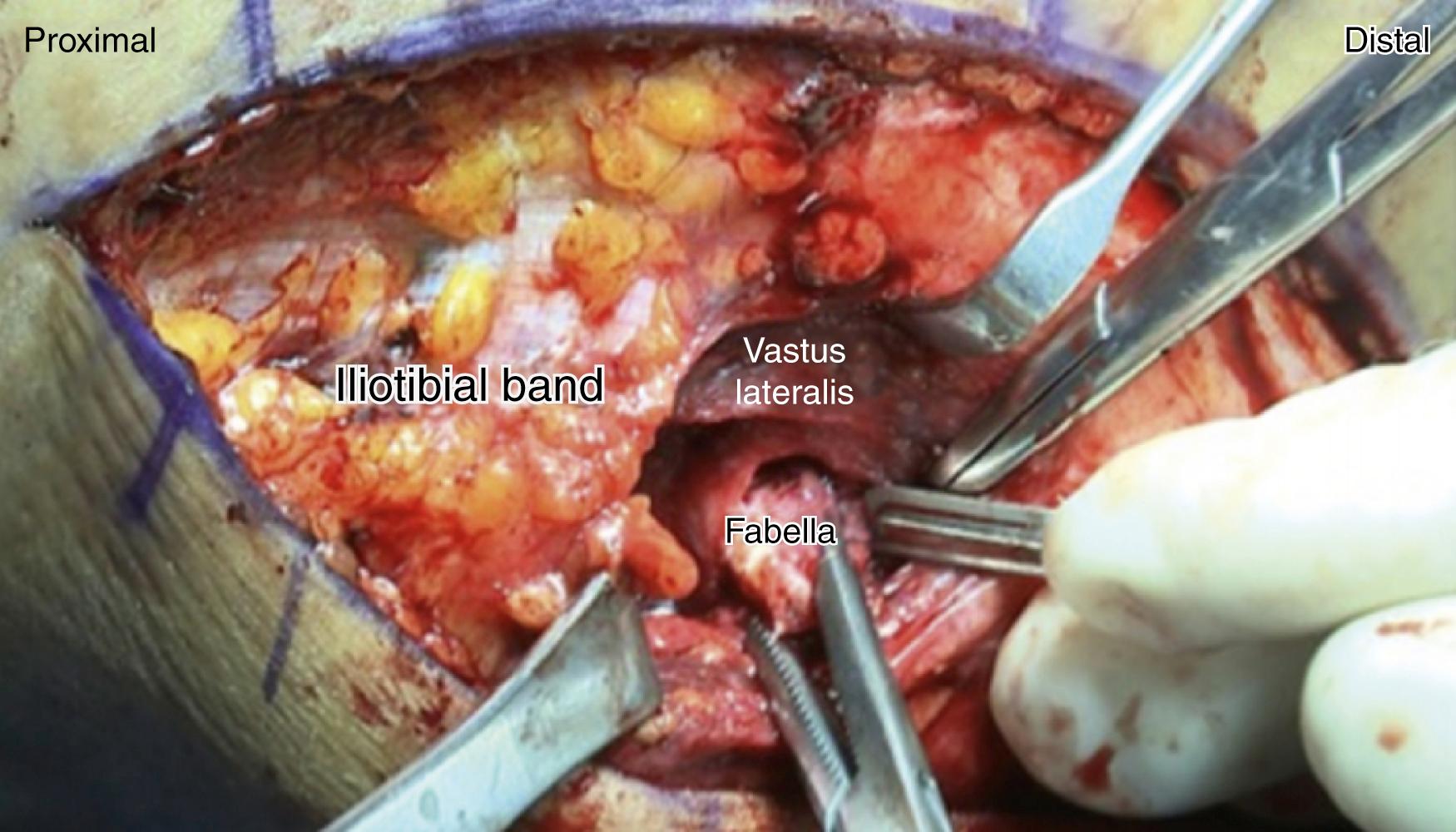 Fig. 37.1, Excision of the fabella performed in a right knee under direct visualisation. After the arthroscopic identification of the fabella and evaluation of the surrounding tissues, the excision is performed. Care must be taken to avoid damage to the lateral gastrocnemius tendon, which is in proximity.