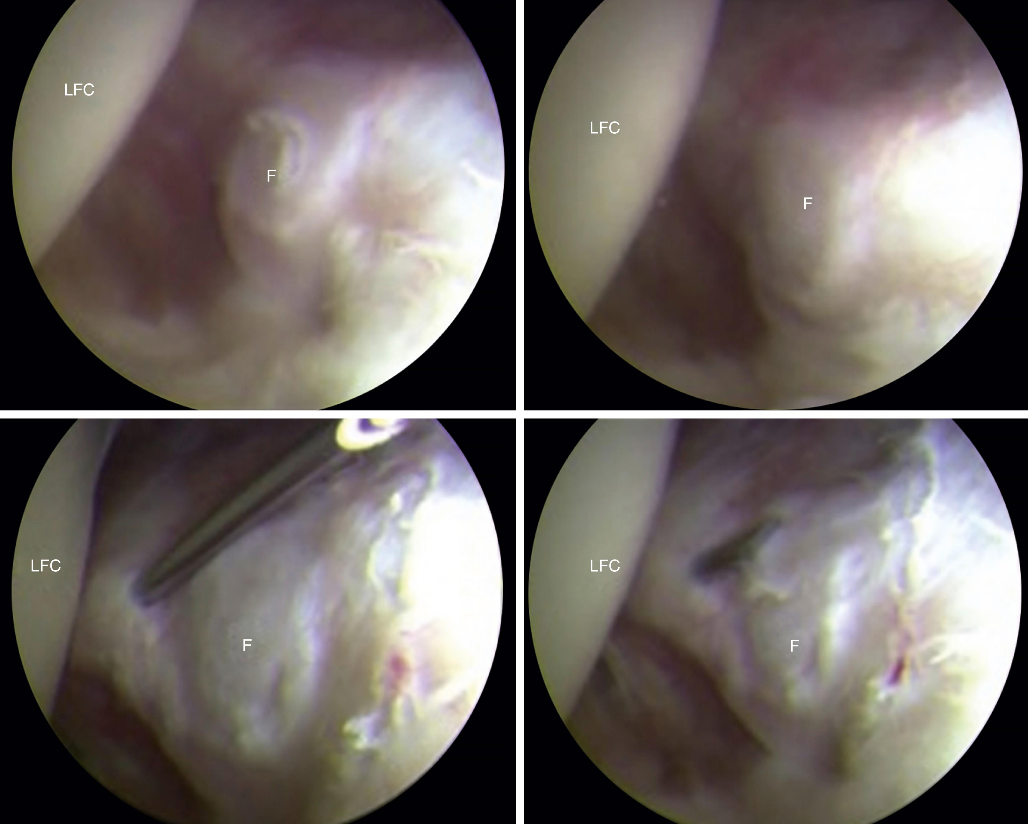 Fig. 37.2, Arthroscopic visualisation of the fabella and the surrounding structures performed in a right knee. The arthroscopic portion of the procedure is performed after the open identification of the fabella. A diagnostic arthroscopy is performed in all the compartments to evaluate associated injuries. After this, a needle is used to delimit the margins of the fabella. This allows for proper identification of the fabella and avoids overresection of the surrounding tissues. F, Fabella; LFC, lateral femoral condyle.