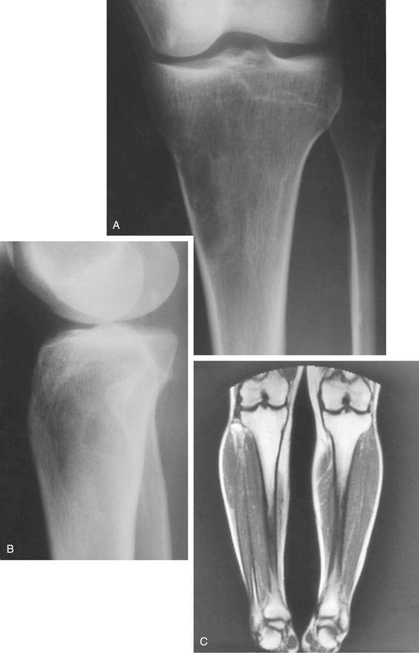 FIGURE 16-1, Intramedullary lipoma: radiographic features.