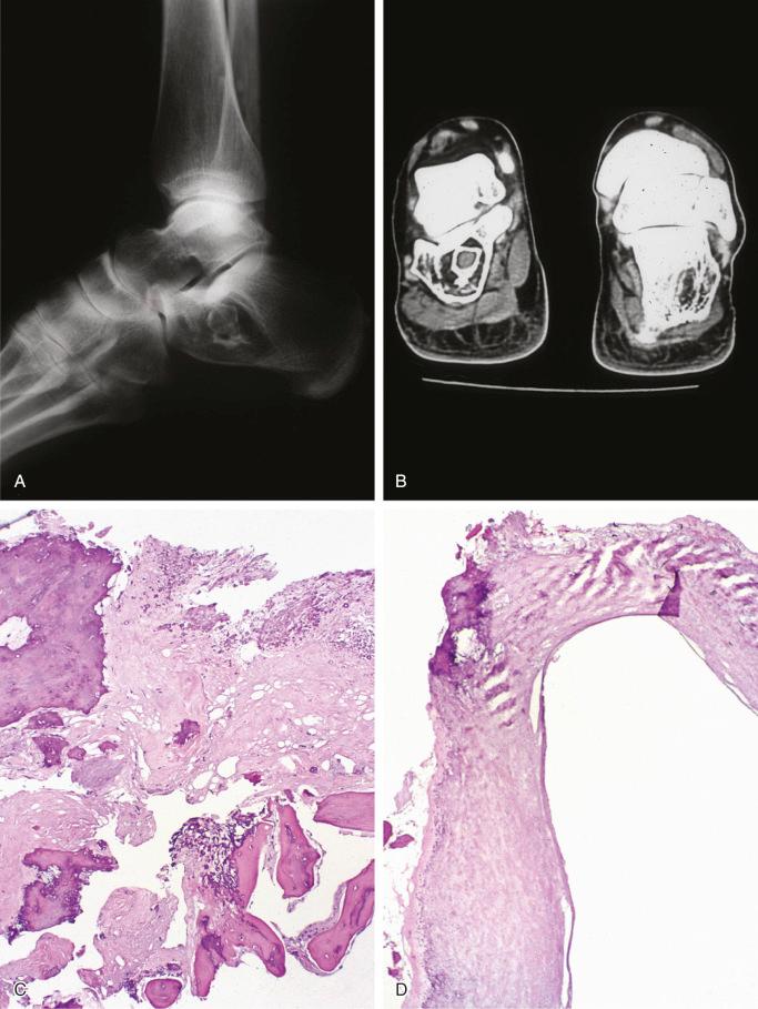 FIGURE 16-3, Lipoma of bone: cystic tumor of calcaneus with fat necrosis.