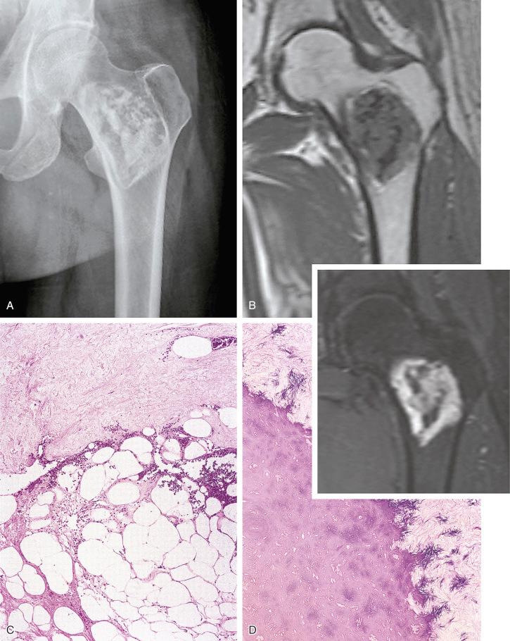 FIGURE 16-4, Intramedullary lipoma: radiographic and microscopic features.