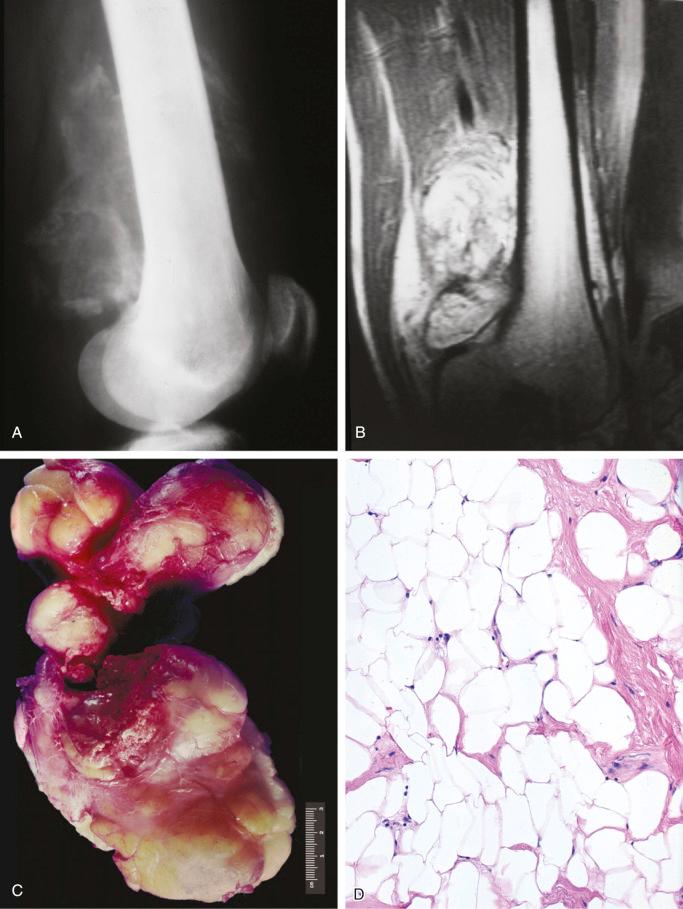 FIGURE 16-5, Parosteal lipoma: radiographic, gross, and microscopic features.