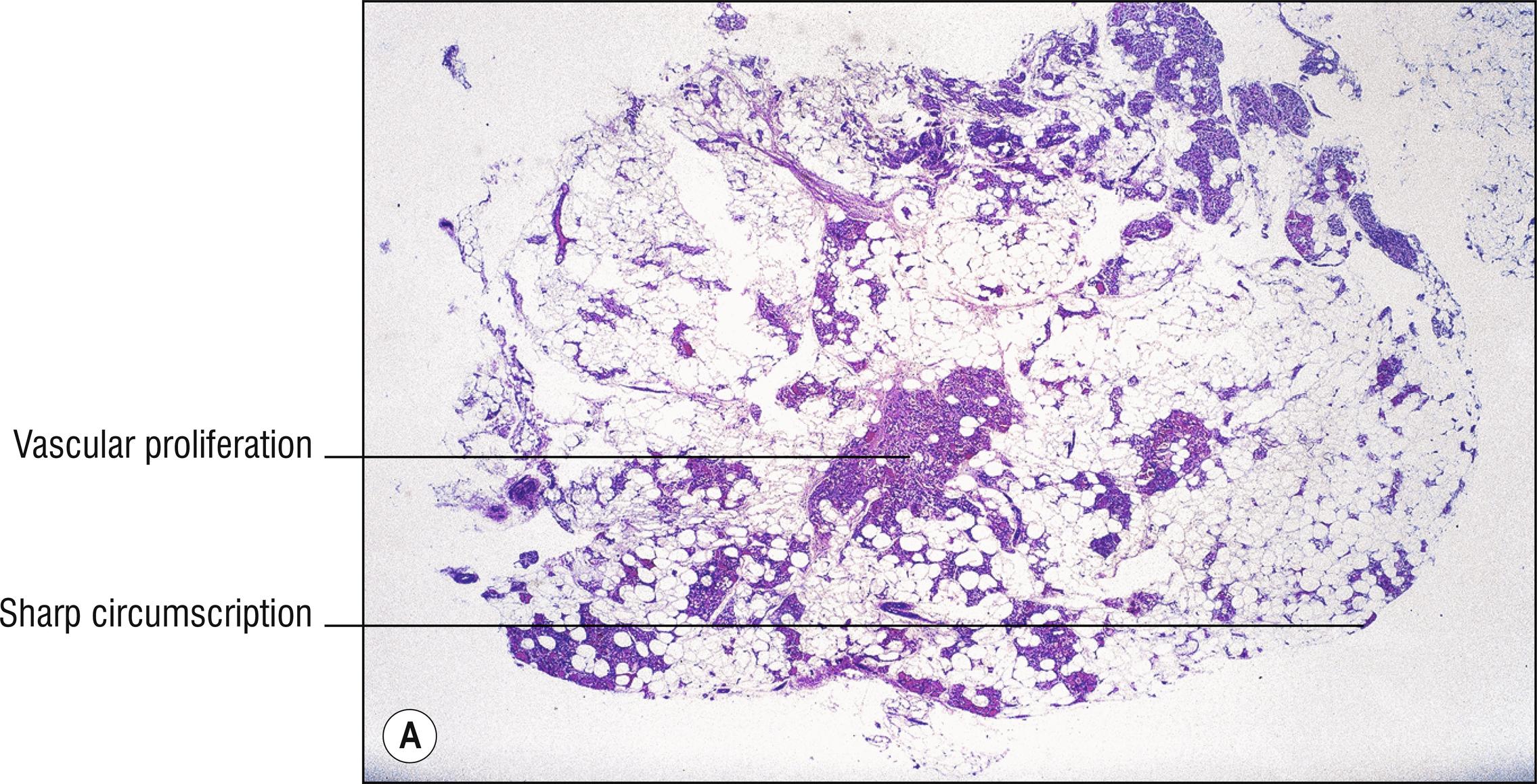 Fig. 29.2, A Angiolipoma (low mag.).