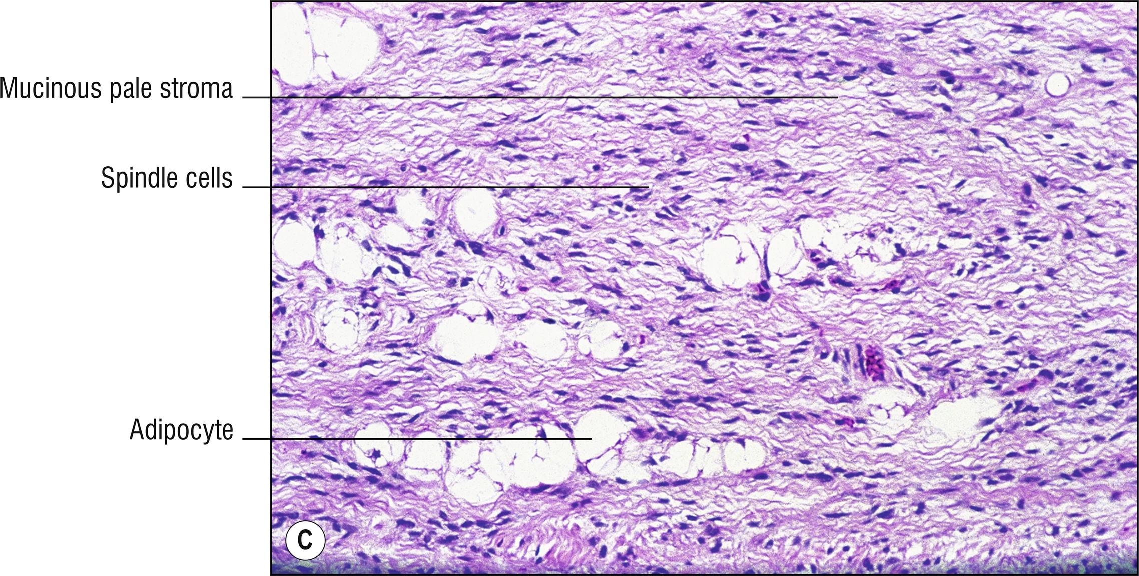 Fig. 29.2, C Spindle cell lipoma.