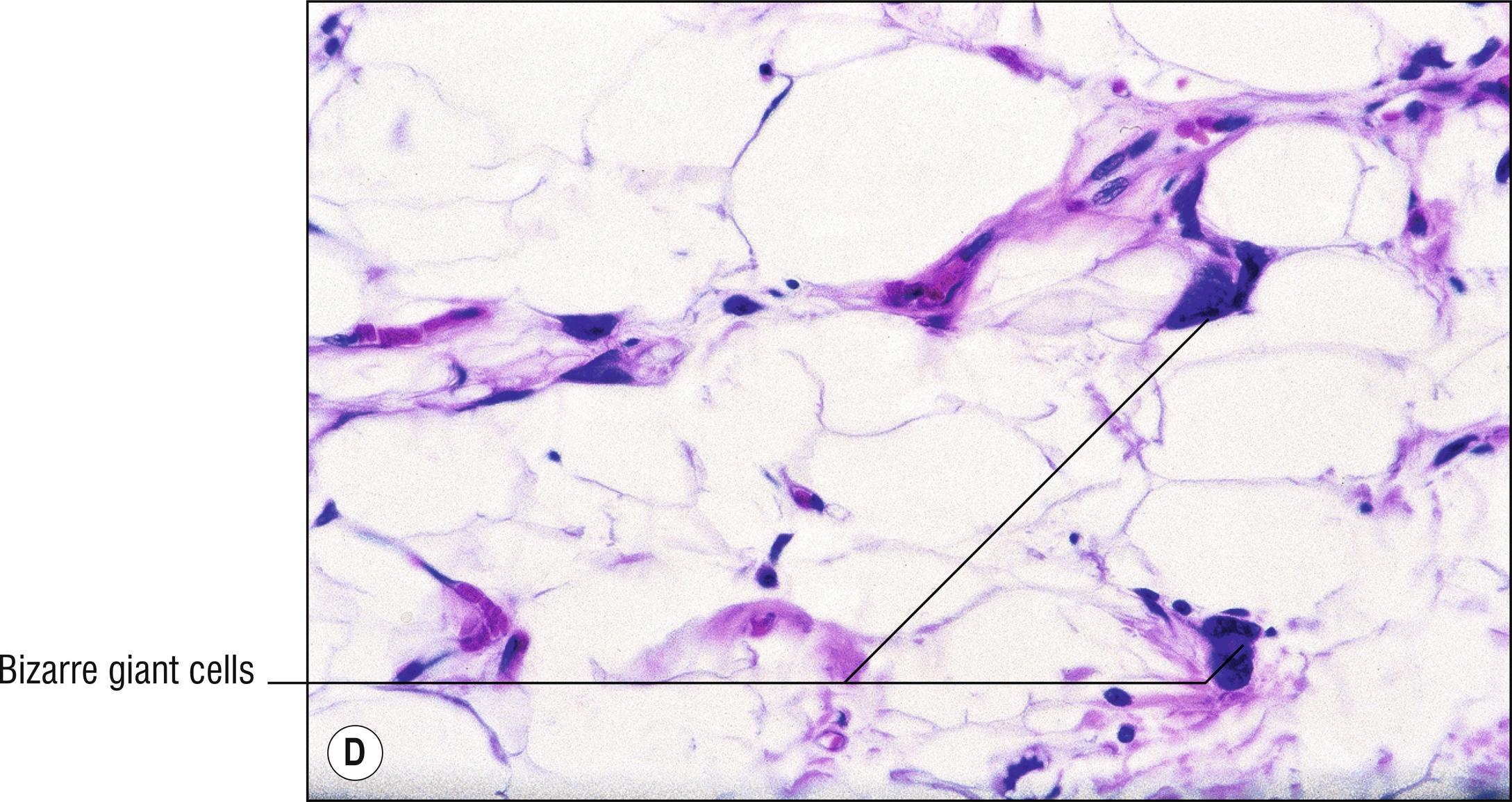 Fig. 29.2, D Pleomorphic lipoma.