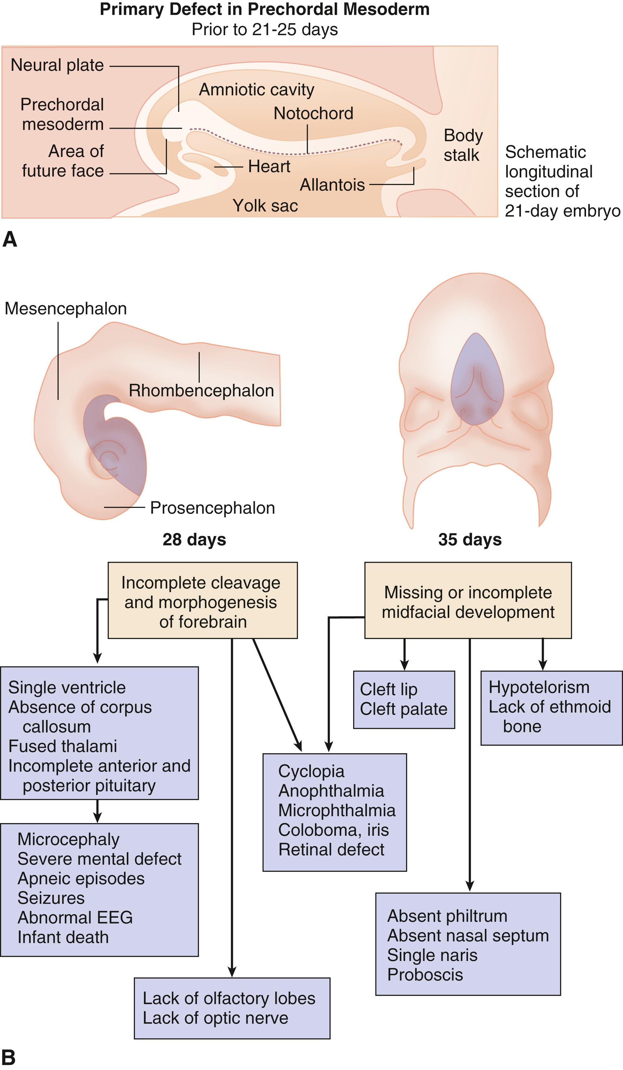 FIGURE 1, Holoprosencephaly sequence.