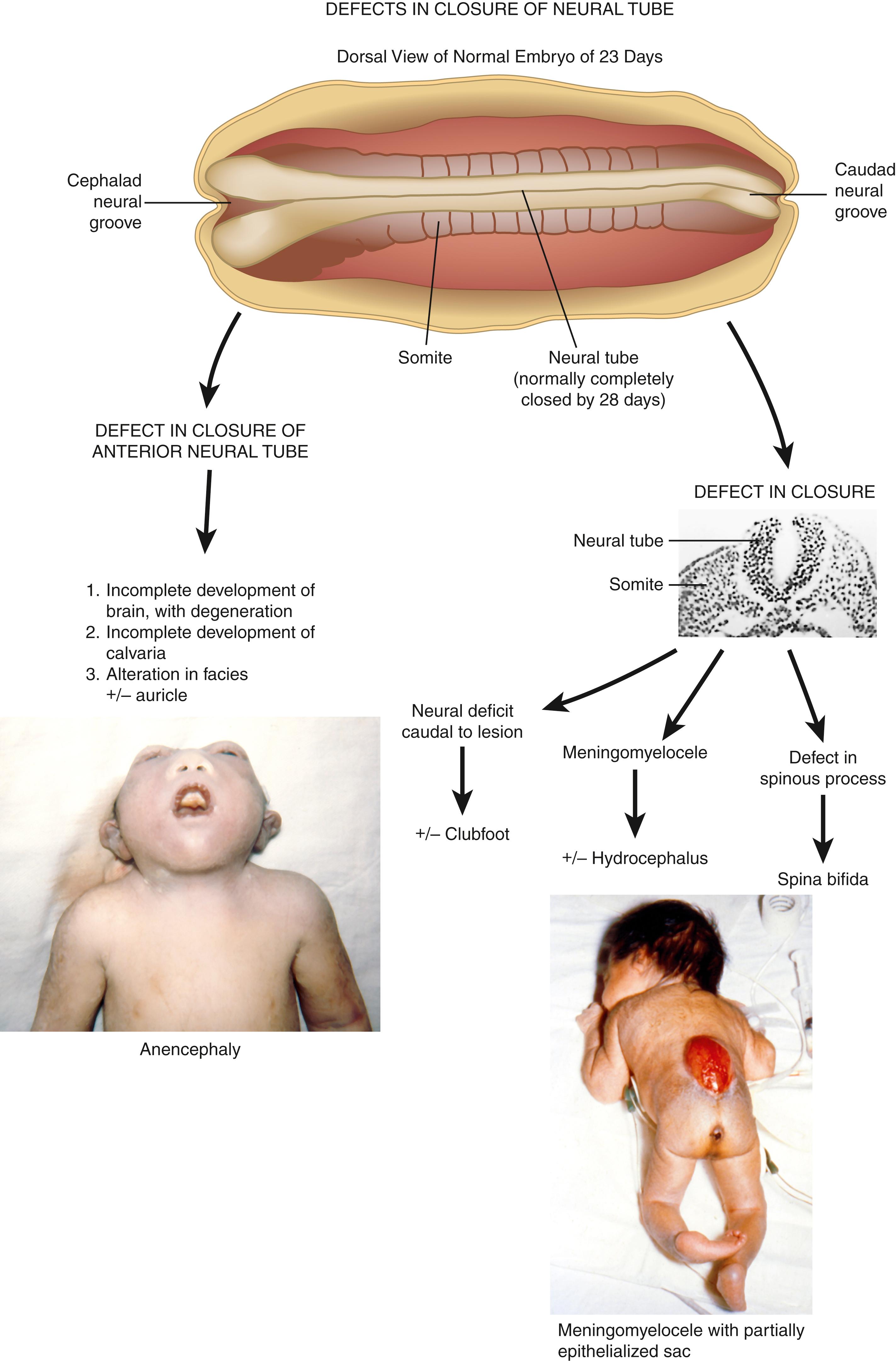 FIGURE 2, Developmental pathogenesis of anencephaly and meningomyelocele.