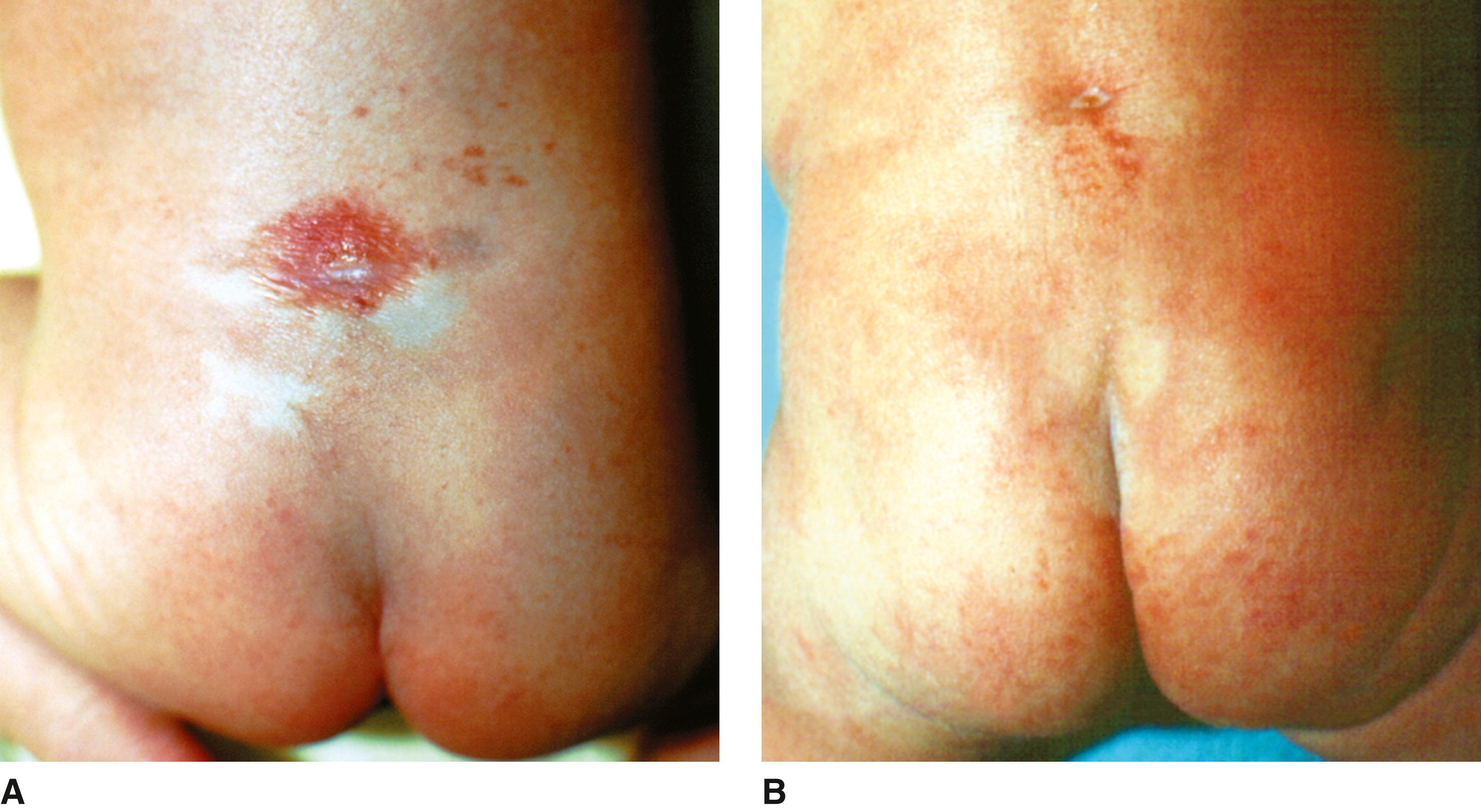 FIGURE 1, Occult spinal dysraphism sequence.