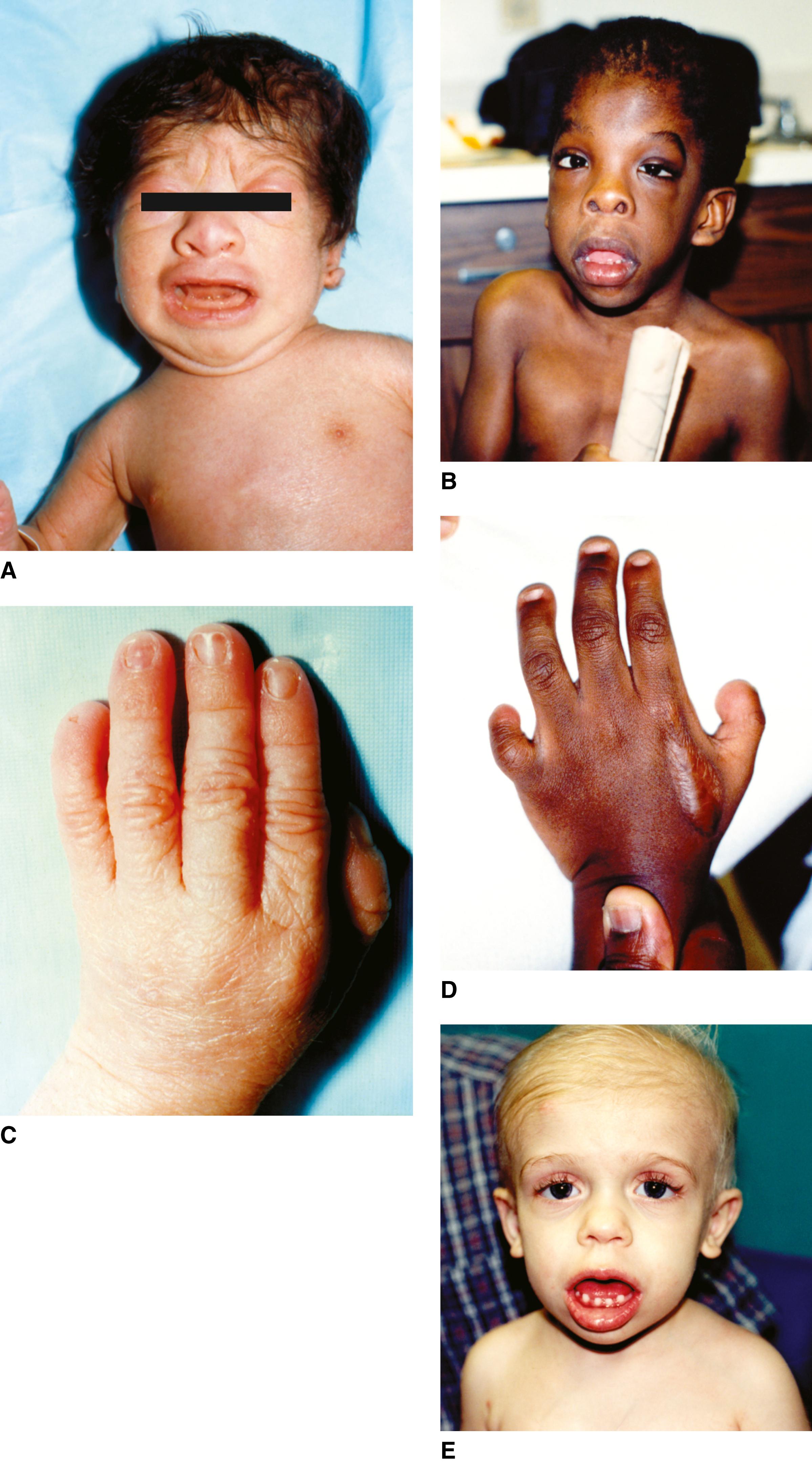 FIGURE 1, Coffin-Siris syndrome.