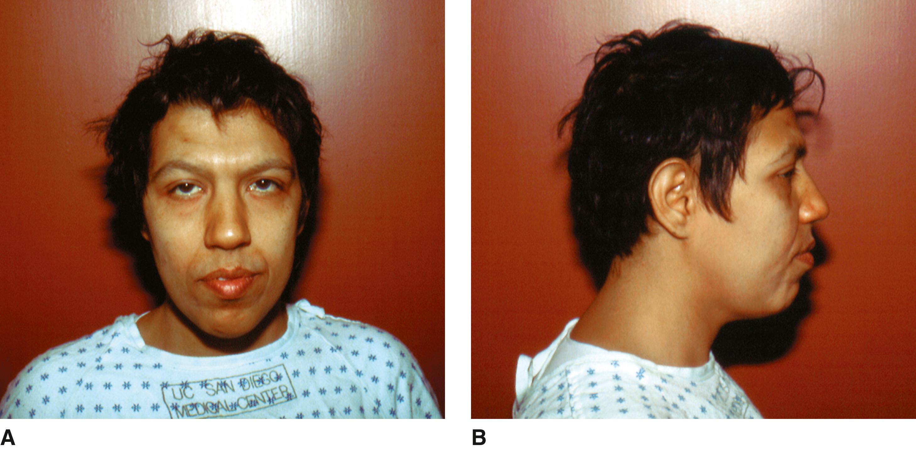 FIGURE 1, Börjeson-Forssman-Lehmann syndrome.