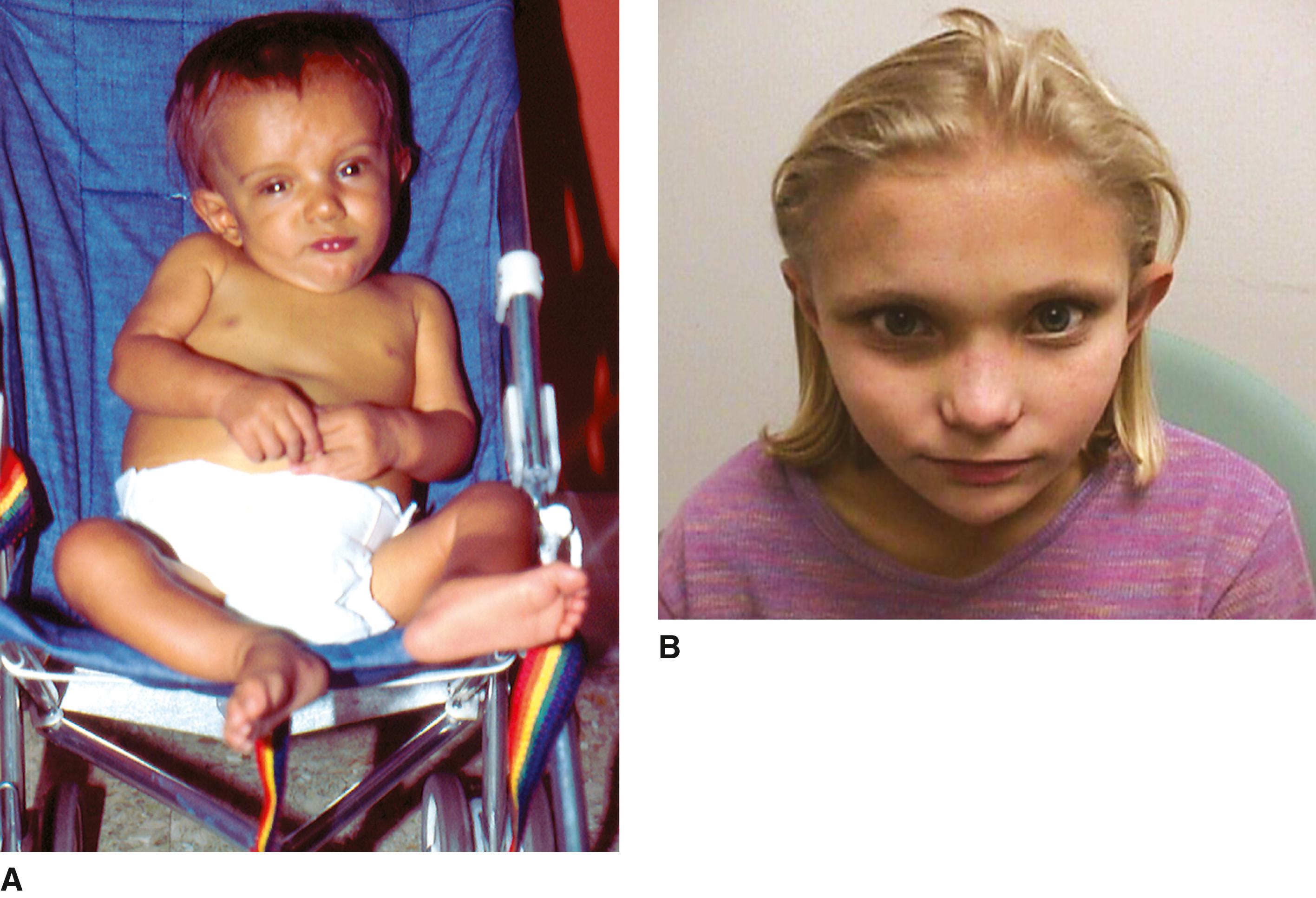 FIGURE 1, Alagille syndrome.