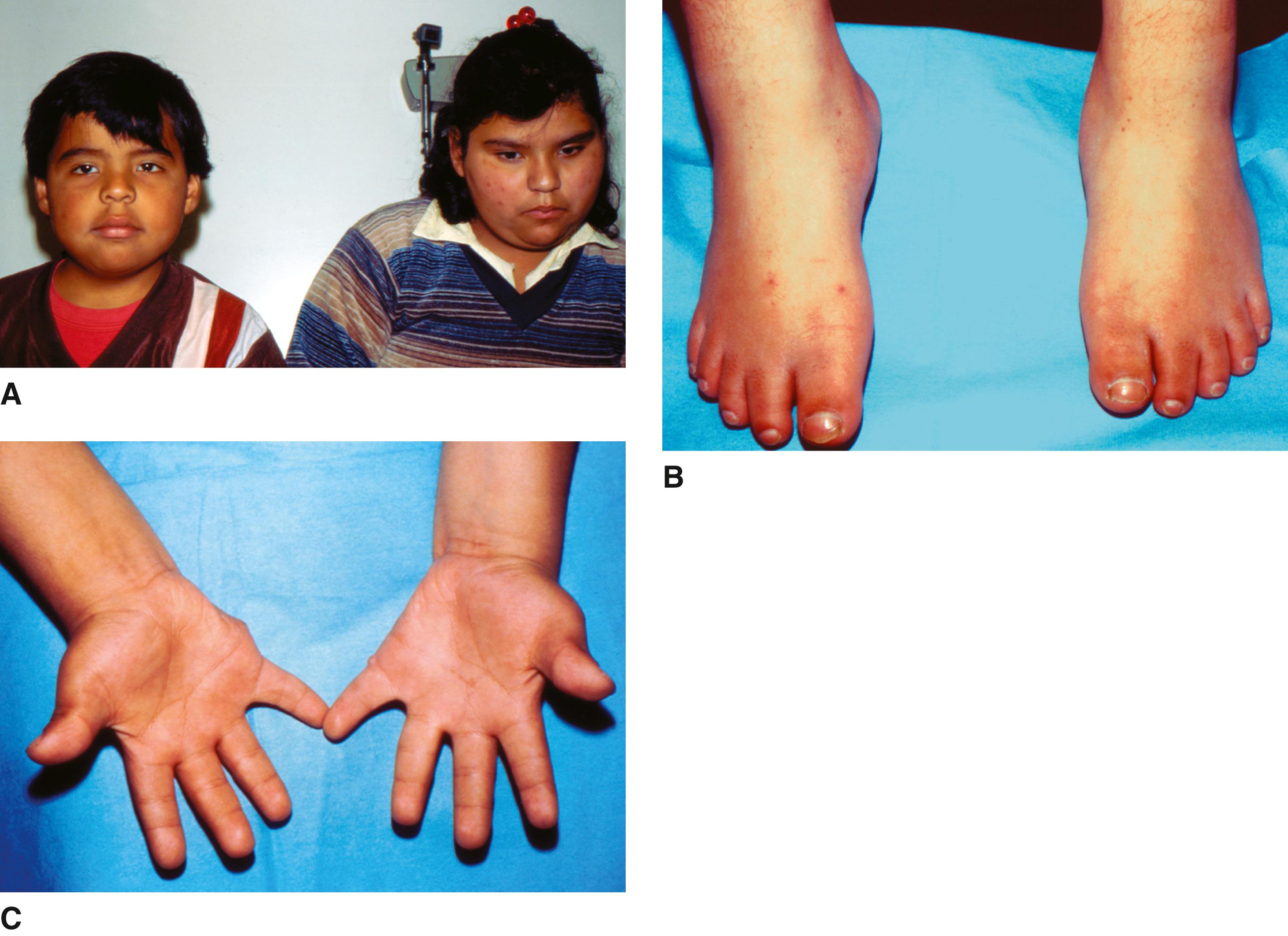 FIGURE 1, Bardet-Biedl syndrome.