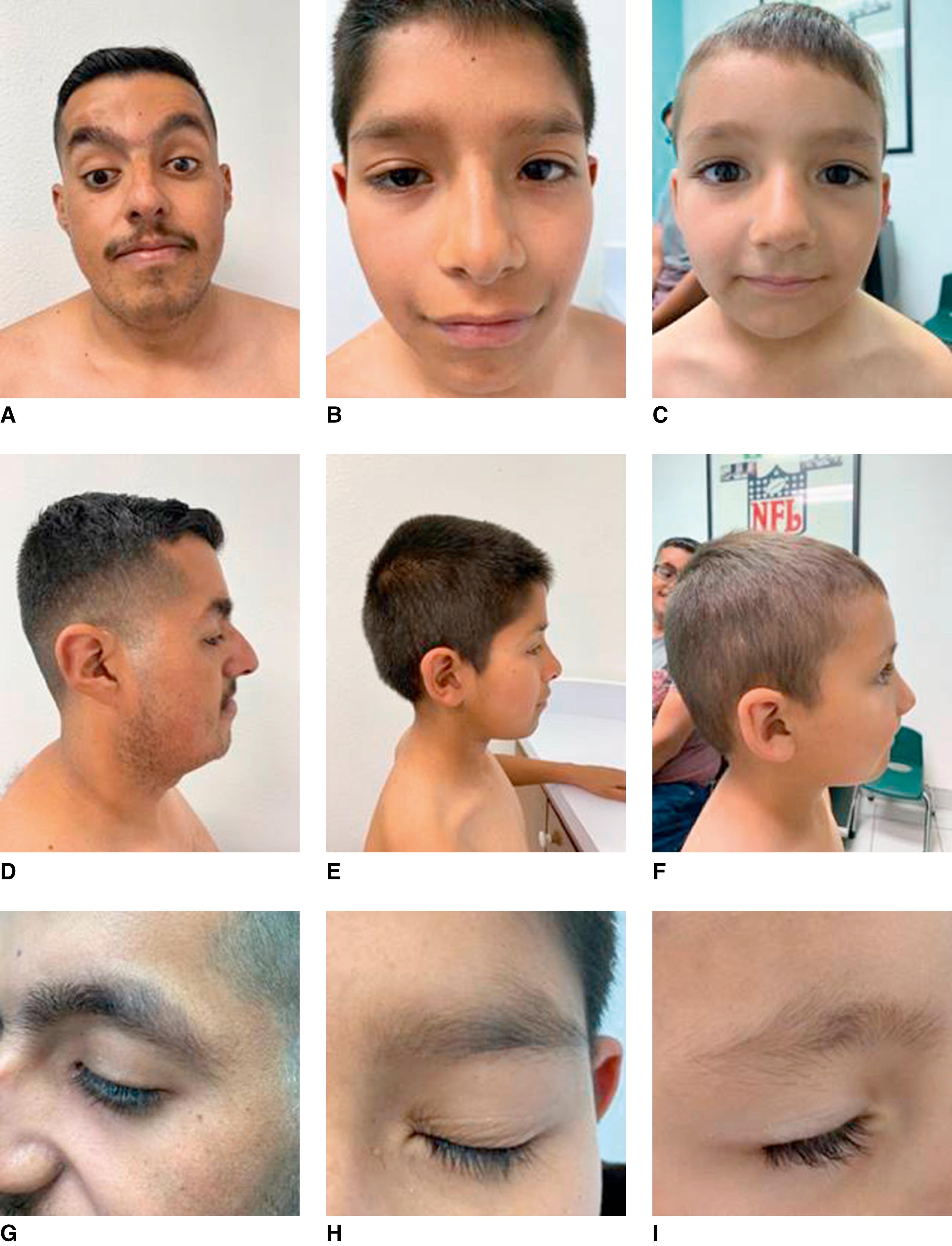 FIGURE 1, A – I , Family with father and two children ages 10 and 5 all with a KMIT2A mutation. Note the ptosis, bulbous tip of the nose and midface hyploplasia, all features being more prominent in the father. Although the upper lip is quite thin in all, the cupid’s bow is well shaped. In all three, the eyebrows are thick; in addition to a medial eyebrow flare, there is a lateral eyebrow flare.