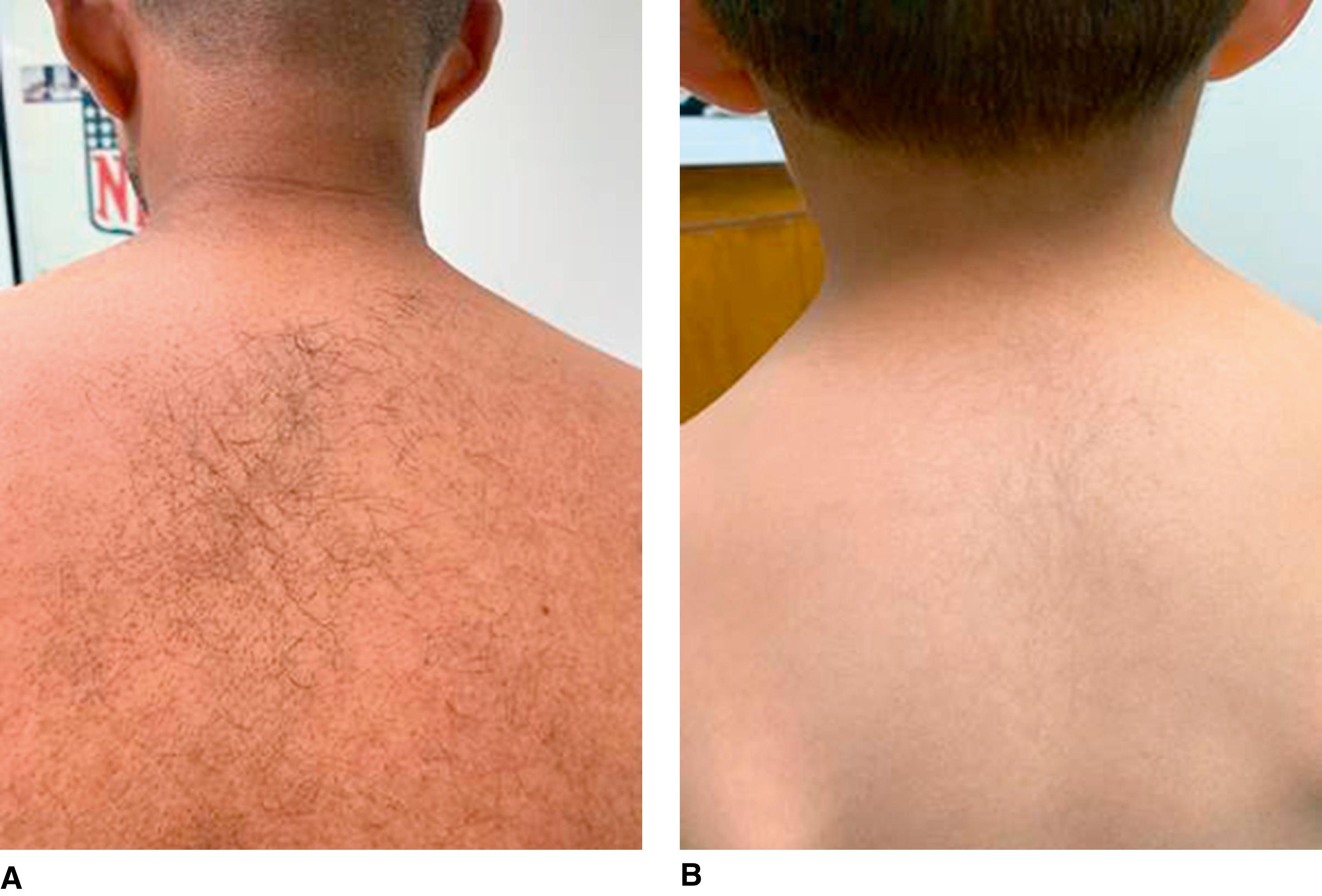 FIGURE 2, Father and younger child had localized hypertrichosis in their back, but not in the elbow or other locations.