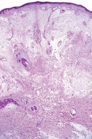 Fig. 1, Superficial angiomyxoma.