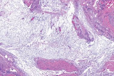 Fig. 2, Juxtaarticular myxoma.