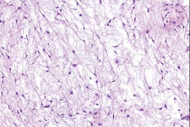 Fig. 4, Juxtaarticular myxoma.