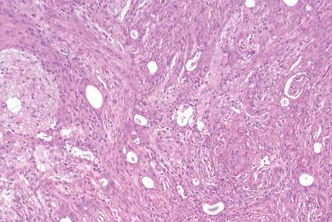 Fig. 2, Ectopic hamartomatous thymoma.