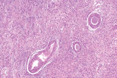 Fig. 3, Ectopic hamartomatous thymoma.