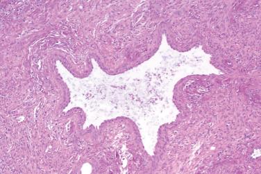 Fig. 4, Ectopic hamartomatous thymoma.