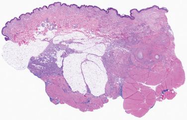 Fig. 1, Hemosiderotic fibrolipomatous tumor.