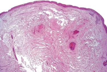 Fig. 2, Superficial angiomyxoma.