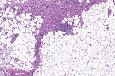 Fig. 2, Hemosiderotic fibrolipomatous tumor.