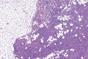 Fig. 3, Hemosiderotic fibrolipomatous tumor.