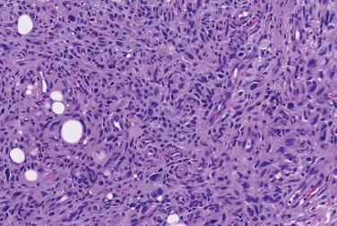 Fig. 4, Hemosiderotic fibrolipomatous tumor.