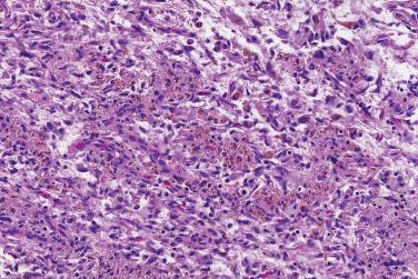 Fig. 6, Hemosiderotic fibrolipomatous tumor.