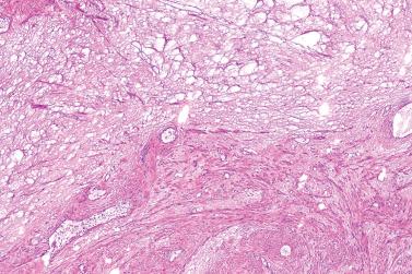 Fig. 1, Deep angiomyxoma.