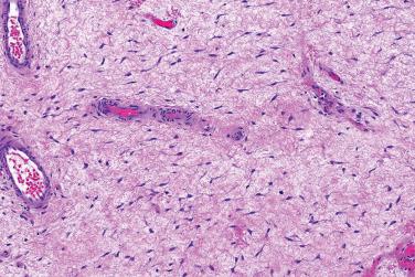 Fig. 3, Deep angiomyxoma.