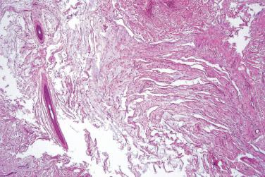 Fig. 3, Superficial angiomyxoma.