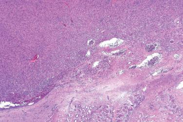 Fig. 3, Atypical fibroxanthoma.