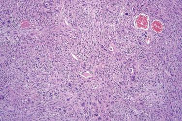 Fig. 4, Atypical fibroxanthoma.