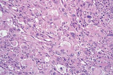 Fig. 5, Atypical fibroxanthoma.