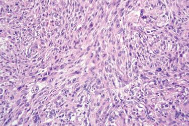 Fig. 6, Atypical fibroxanthoma.