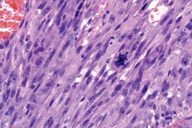 Fig. 7, Atypical fibroxanthoma.