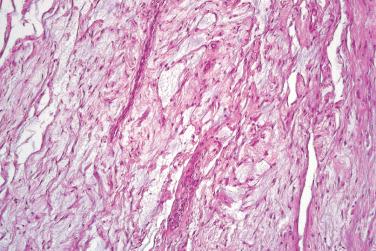 Fig. 4, Superficial angiomyxoma.