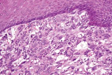 Fig. 8, Atypical fibroxanthoma.