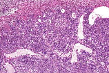 Fig. 9, Atypical fibroxanthoma.