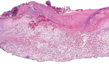 Fig. 10, Atypical fibroxanthoma.