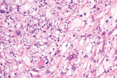 Fig. 11, Atypical fibroxanthoma with clear cell change